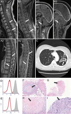 Chronic Granulomatous Disease First Diagnosed in Adulthood Presenting With Spinal Cord Infection